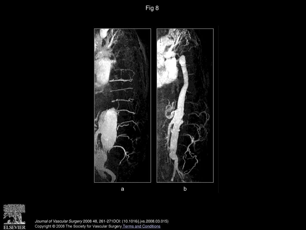 Magnetic Resonance Angiography Of Collateral Blood Supply To Spinal